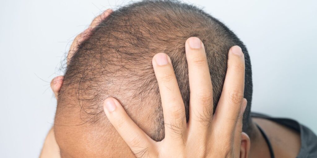 Hair loss drug probed in Europe over link to suicidal